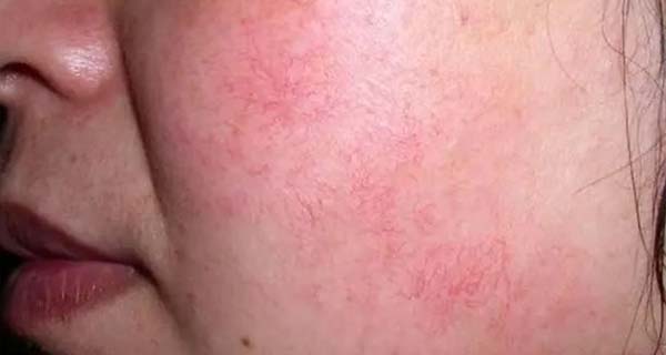 Natural anti-itch and soothing essence